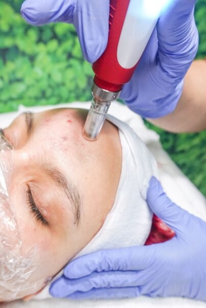 Séance de microneedling Bruxelles sur une peau à imperfections