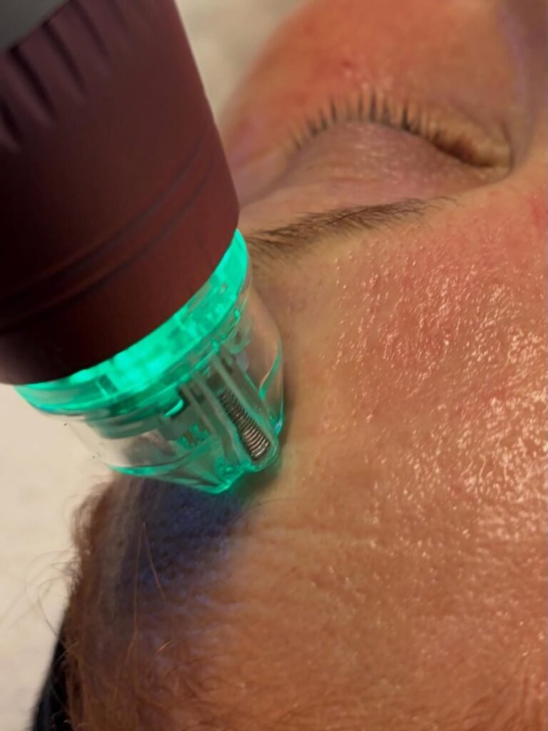 Microneedling réalisé à l’institut Esthétique Angelika