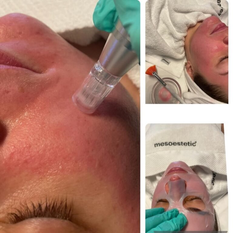 Microneedling réalisé à l’institut Esthétique Angelika