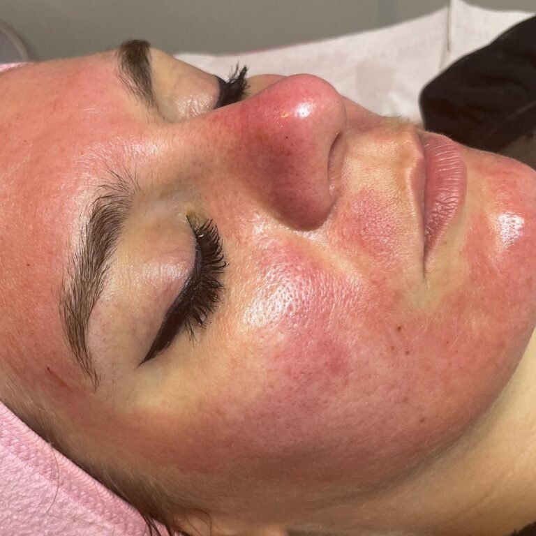 Microneedling réalisé à l’institut Esthétique Angelika